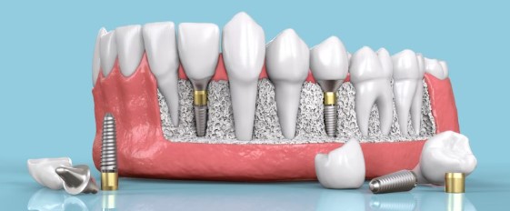Benefits of Dental Implants