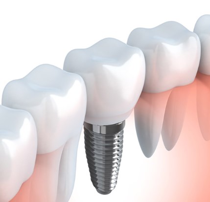 Benefits Of Dental Implants, advantages of tooth implants, perks of dental implantation, dental implant benefits, pros of teeth implants, merits of dental restoration, dental implant advantages, benefits of implantsupported teeth, positive aspects of dental implants, gains of tooth replacement, dental implant perks, advantages of implant dentistry, benefits of permanent tooth replacement, dental implant benefits and advantages, merits of dental prosthetics, benefits of oral implant surgery, pros of dental implantology, advantages of dental implant technology, dental implant benefits for oral health, benefits of implantsupported dentures, advantages of permanent dental restoration, benefits of implantsupported bridges, perks of dental implant therapy, merits of implantbased tooth replacement, dental implant benefits and perks